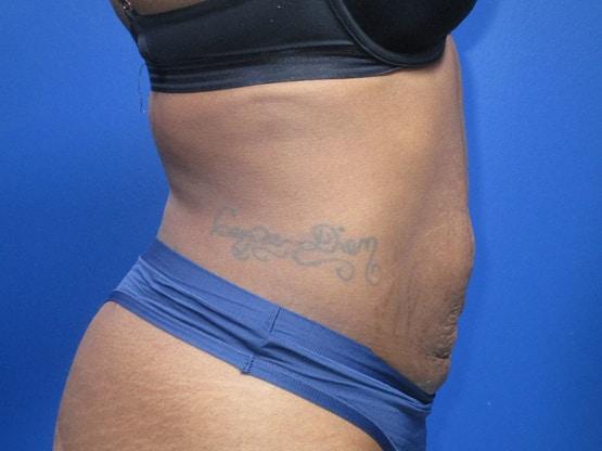 Liposuction after at Dr. Tambra R. Garrett, MD, Fort Worth in Fort Worth, TX