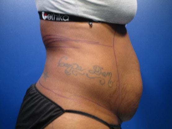 Liposuction before at Dr. Tambra R. Garrett, MD, Fort Worth in Fort Worth, TX