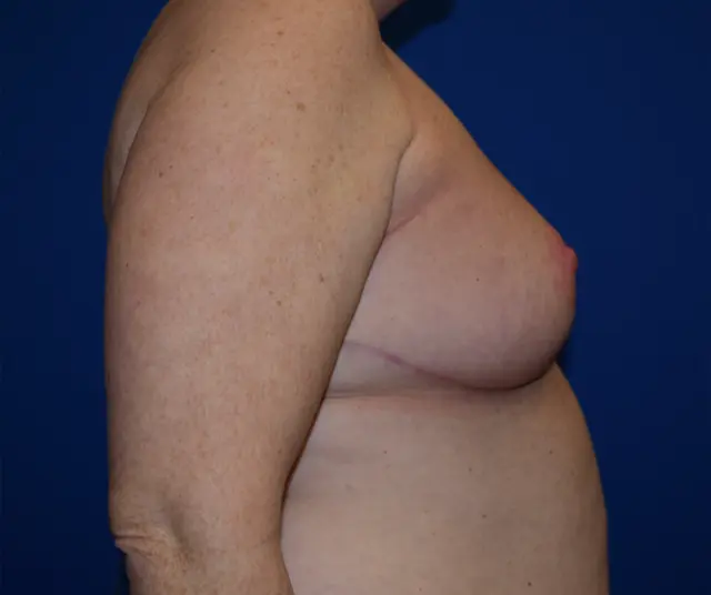 Breast Reduction after at DePerro Plastic Surgery in Columbus, OH