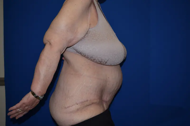 DePerro Plastic Surgery after — Columbus, OH