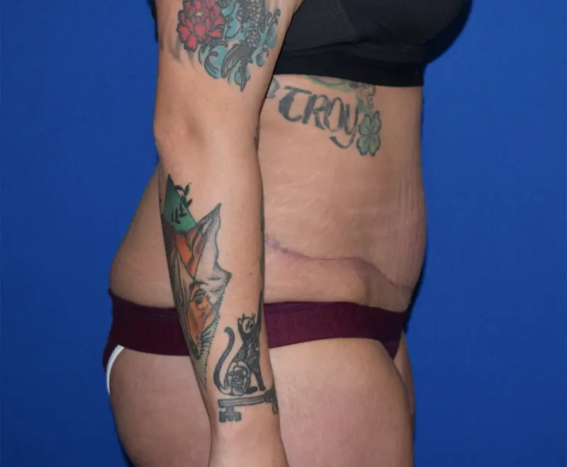 DePerro Plastic Surgery tummy tuck after — Columbus, OH
