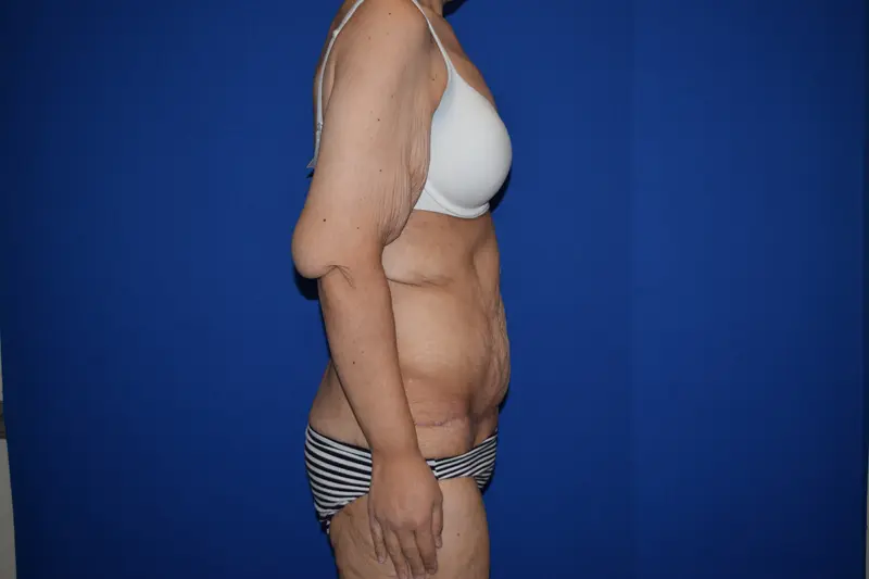 DePerro Plastic Surgery after — Columbus, OH