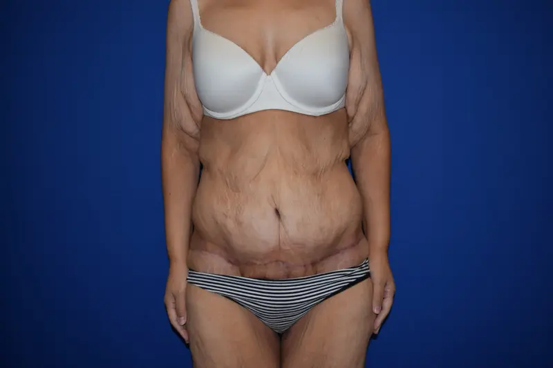 DePerro Plastic Surgery after — Columbus, OH