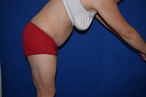 Tummy Tuck before at DePerro Plastic Surgery in Columbus, OH