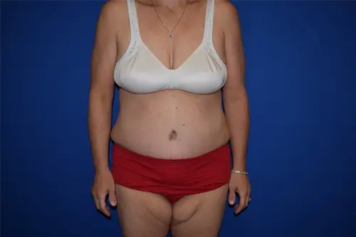 Tummy Tuck before at DePerro Plastic Surgery in Columbus, OH