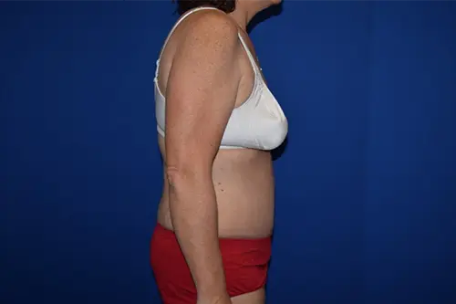 Tummy Tuck before at DePerro Plastic Surgery in Columbus, OH