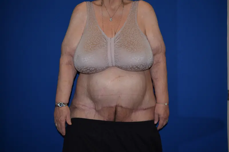 DePerro Plastic Surgery after — Columbus, OH