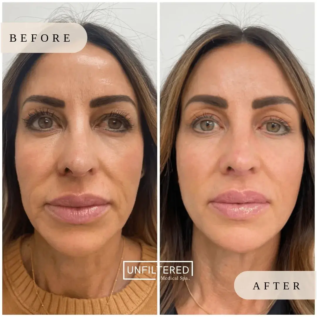 Unfiltered Medical Spa skin tightening result — Lehi, UT