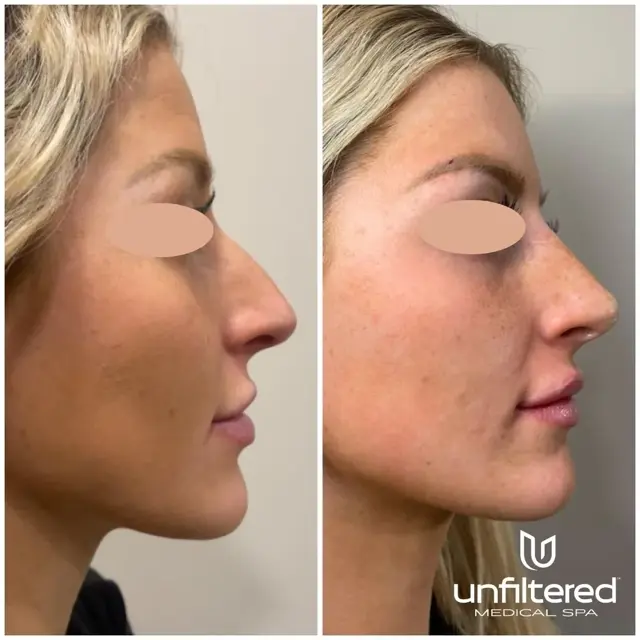 Rhinoplasty result at Unfiltered Medical Spa in Lehi, UT