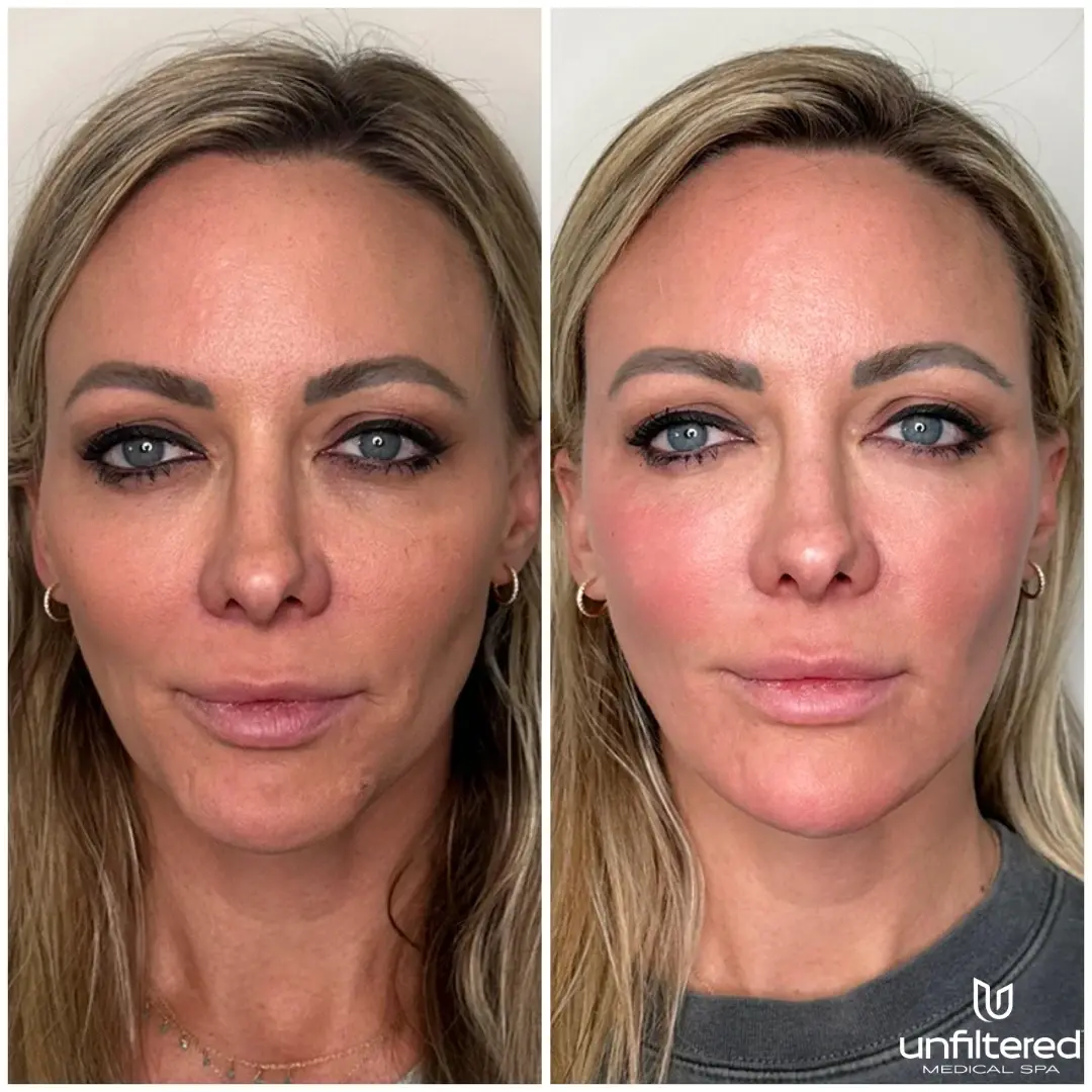 Unfiltered Medical Spa skin tightening result — Lehi, UT