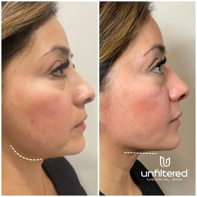 Kybella result at Unfiltered Medical Spa in Lehi, UT