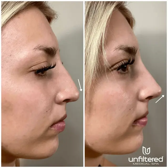 Liquid Rhinoplasty result at Unfiltered Medical Spa in Lehi, UT