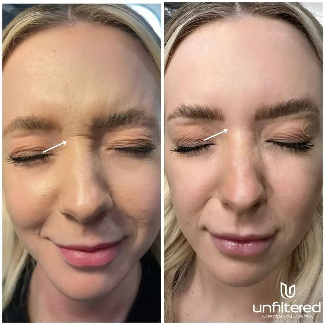 Unfiltered Medical Spa botox result — Lehi, UT