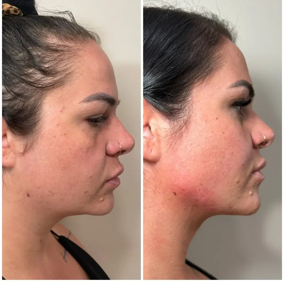 Unfiltered Medical Spa jawline filler result — Lehi, UT