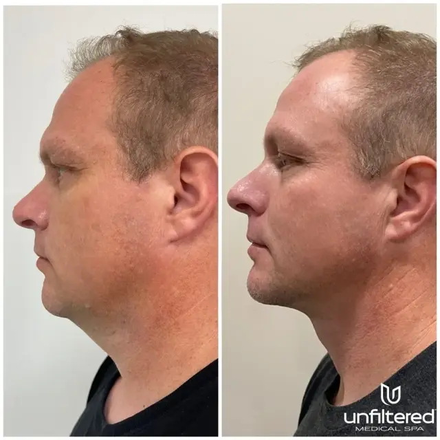 Kybella result at Unfiltered Medical Spa in Lehi, UT