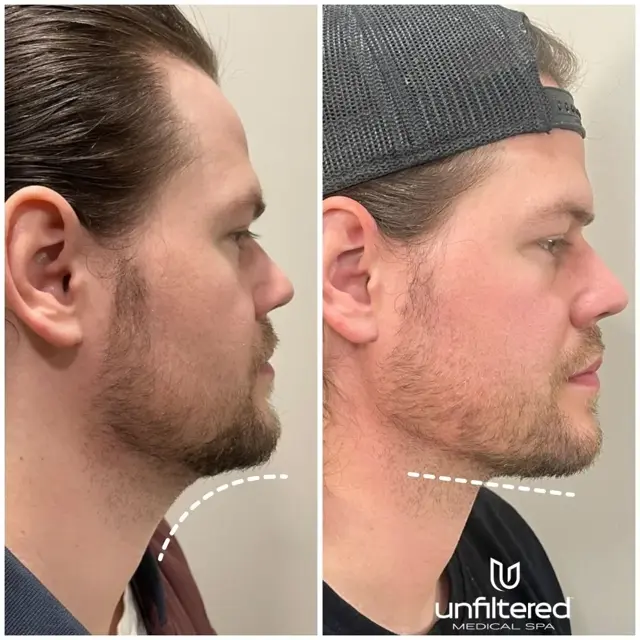 Kybella result at Unfiltered Medical Spa in Lehi, UT