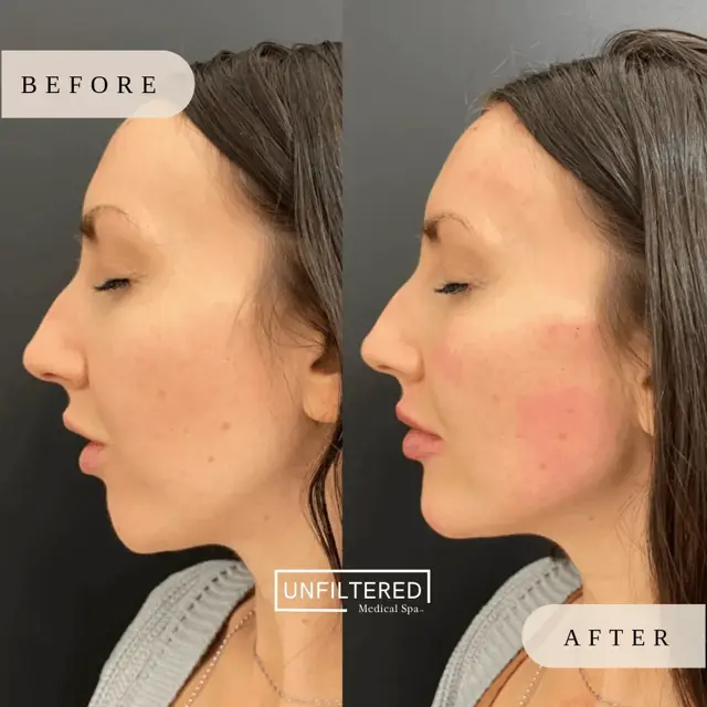 Jawline Filler result at Unfiltered Medical Spa in Lehi, UT