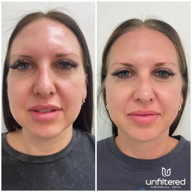 Kybella result at Unfiltered Medical Spa in Lehi, UT