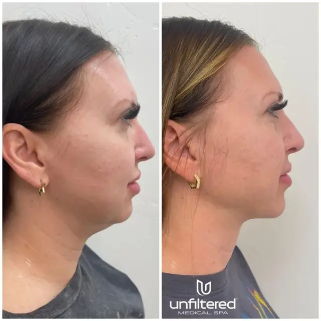Kybella result at Unfiltered Medical Spa in Lehi, UT