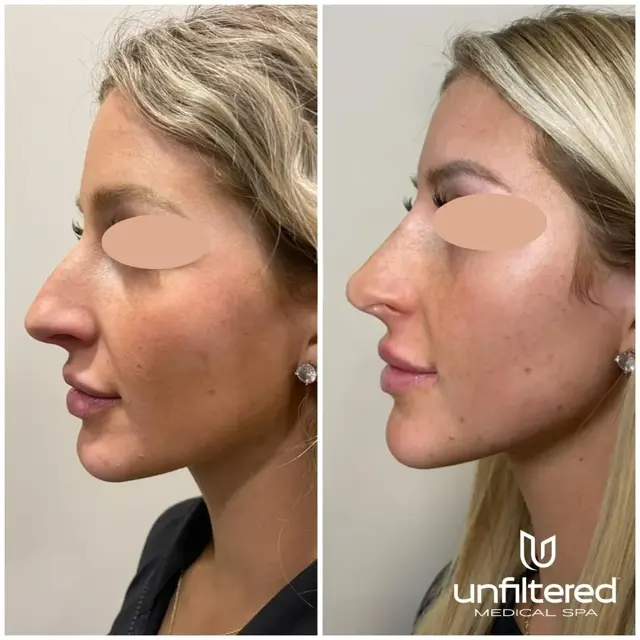 Liquid Rhinoplasty result at Unfiltered Medical Spa in Lehi, UT