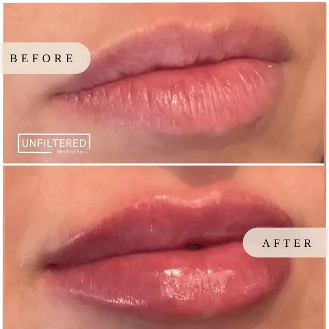 Lip Filler result at Unfiltered Medical Spa in Lehi, UT
