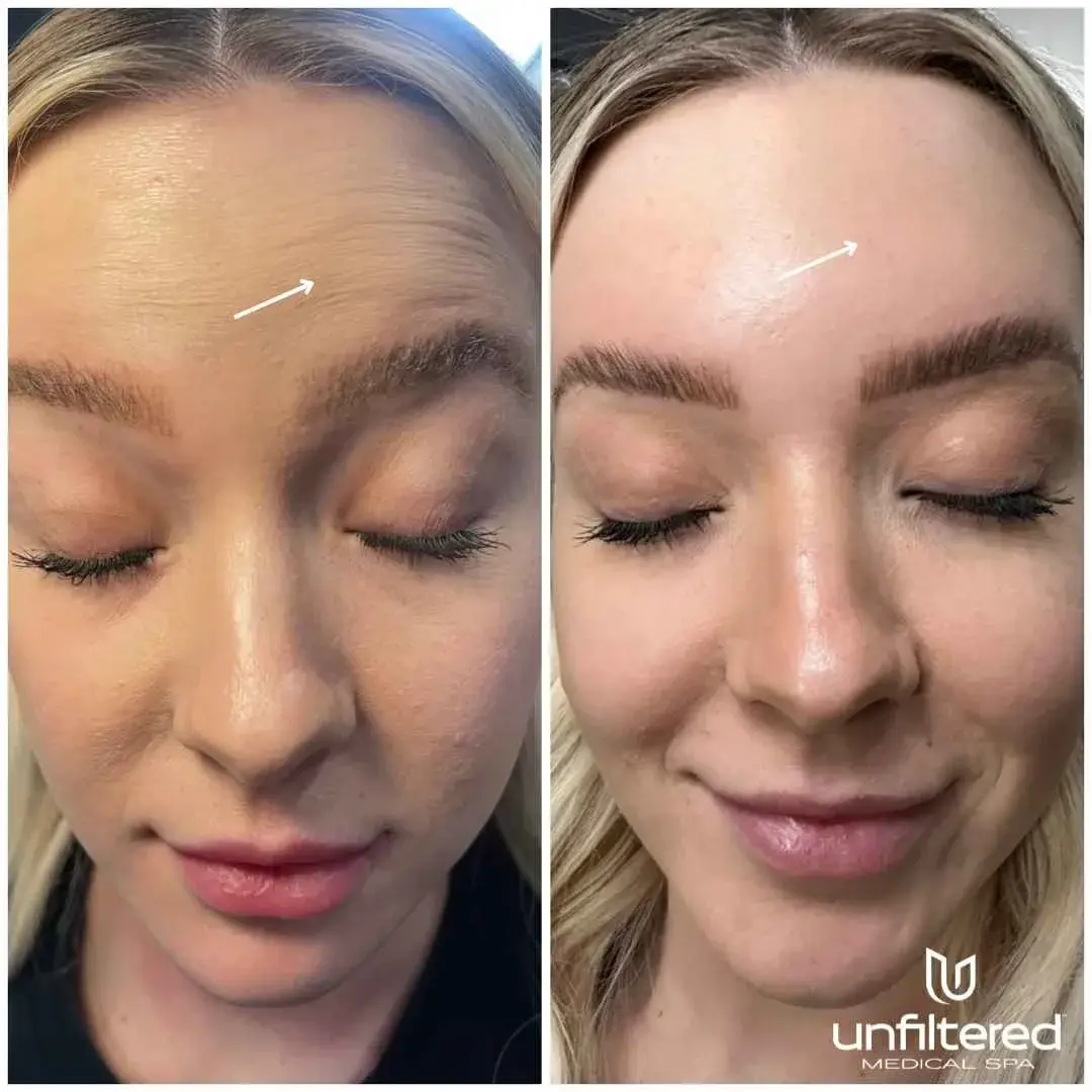 Unfiltered Medical Spa botox result — Lehi, UT