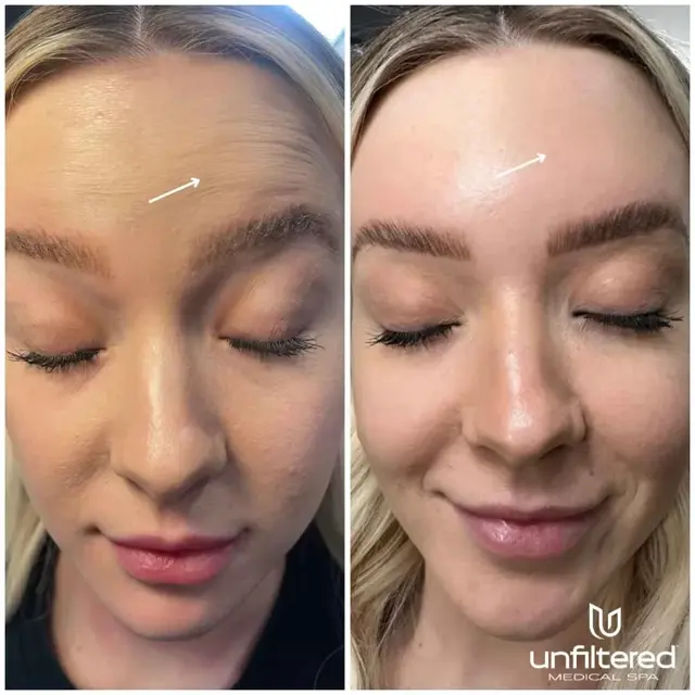 Botox result at Unfiltered Medical Spa in Lehi, UT