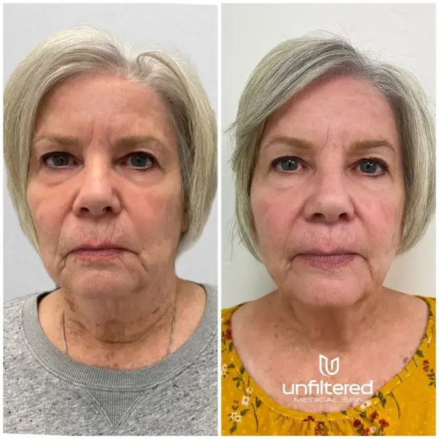 Kybella result at Unfiltered Medical Spa in Lehi, UT
