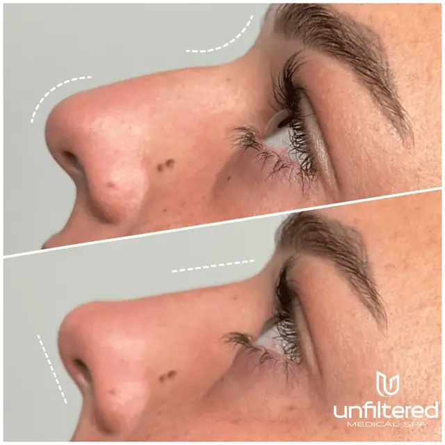 Liquid Rhinoplasty result at Unfiltered Medical Spa in Lehi, UT