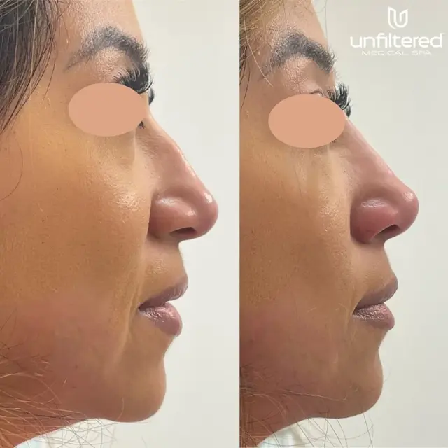 Liquid Rhinoplasty result at Unfiltered Medical Spa in Lehi, UT