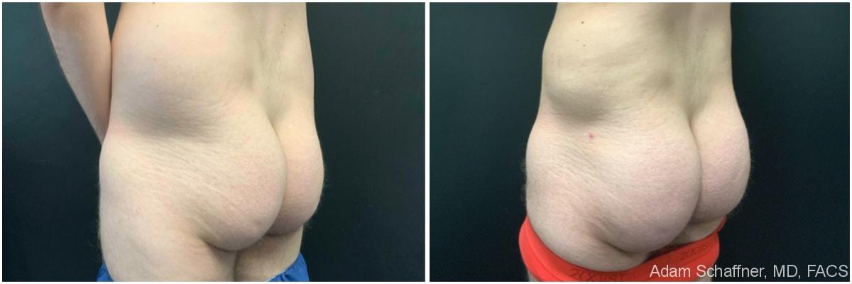 Adam Schaffner, MD, FACS bbl result — New York, NY