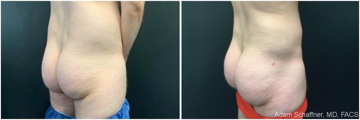 Adam Schaffner, MD, FACS bbl result — New York, NY