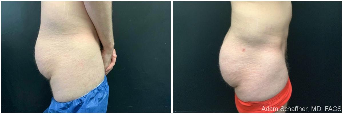 Adam Schaffner, MD, FACS bbl result — New York, NY