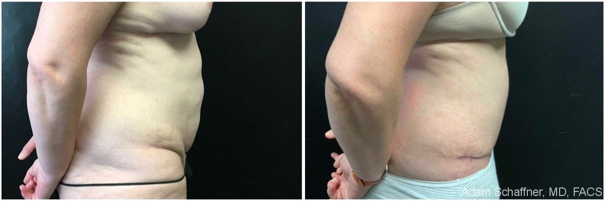 Adam Schaffner, MD, FACS tummy tuck result — New York, NY