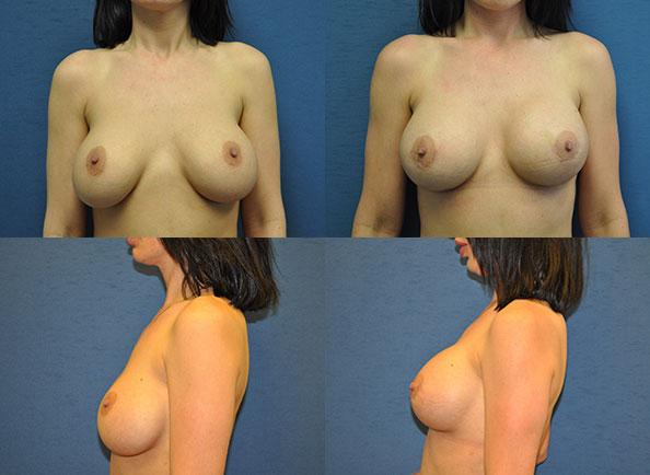 Breast Lift result at Dr. Daniel Casper in Los Angeles, CA