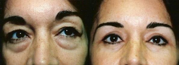 Dr. Daniel Casper blepharoplasty result — Los Angeles, CA