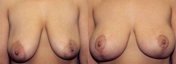 Breast Lift result at Dr. Daniel Casper in Los Angeles, CA