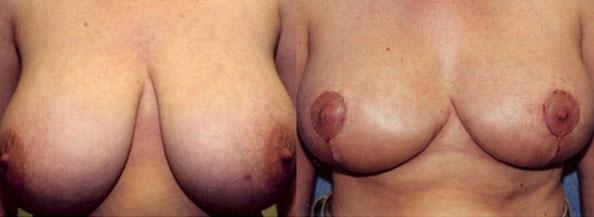 Breast Reduction result at Dr. Daniel Casper in Los Angeles, CA