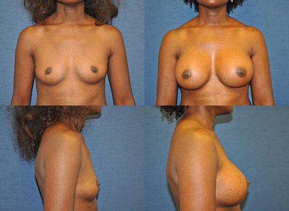 Breast Augmentation result at Dr. Daniel Casper in Los Angeles, CA
