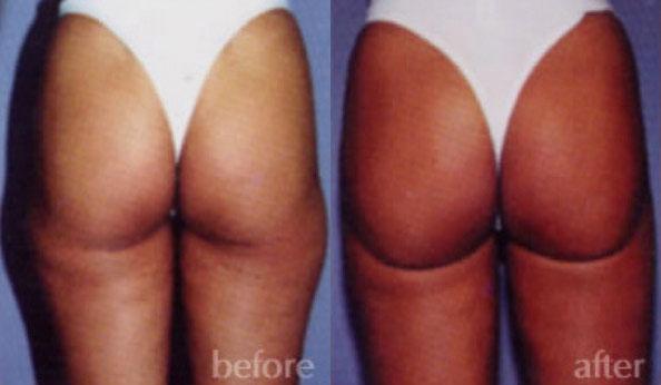 Liposuction result at Dr. Daniel Casper in Los Angeles, CA