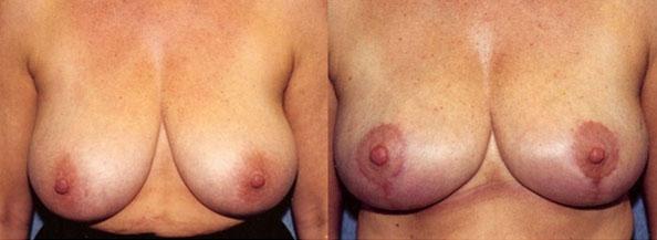 Breast Reduction result at Dr. Daniel Casper in Los Angeles, CA