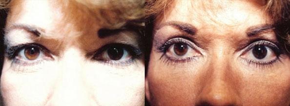Dr. Daniel Casper blepharoplasty result — Los Angeles, CA