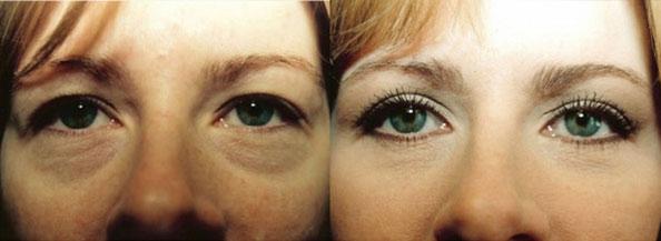 Blepharoplasty result at Dr. Daniel Casper in Los Angeles, CA