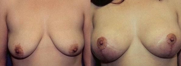 Breast Lift result at Dr. Daniel Casper in Pasadena, CA