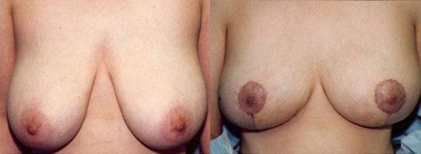 Breast Reduction result at Dr. Daniel Casper in Pasadena, CA