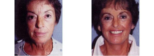 Facelift result at Dr. Daniel Casper in Los Angeles, CA