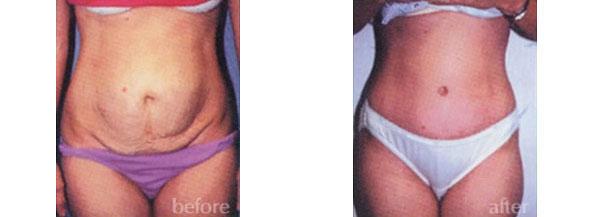 Tummy Tuck result at Dr. Daniel Casper in Los Angeles, CA