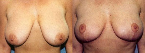 Breast Reduction result at Dr. Daniel Casper in Los Angeles, CA