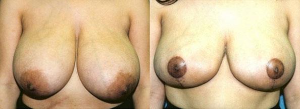 Breast Reduction result at Dr. Daniel Casper in Los Angeles, CA