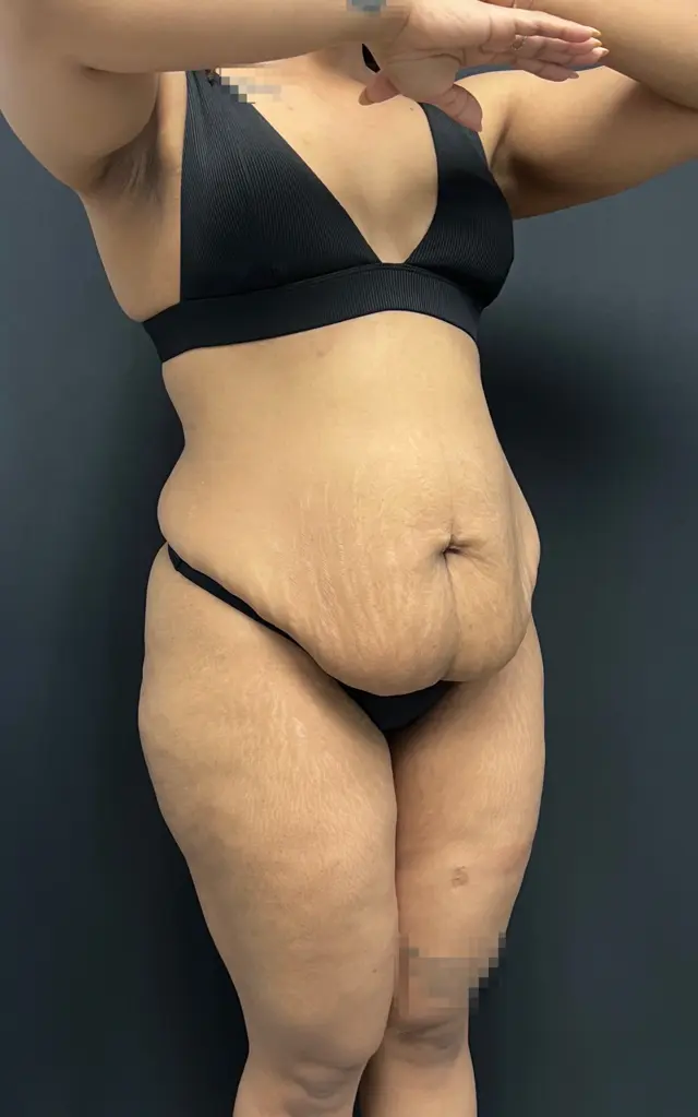 Tummy Tuck before at Mafi Plastic Surgery in Fresno, CA